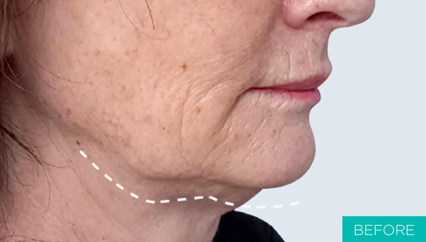 Before jaw line lifting with MINT PDO threads