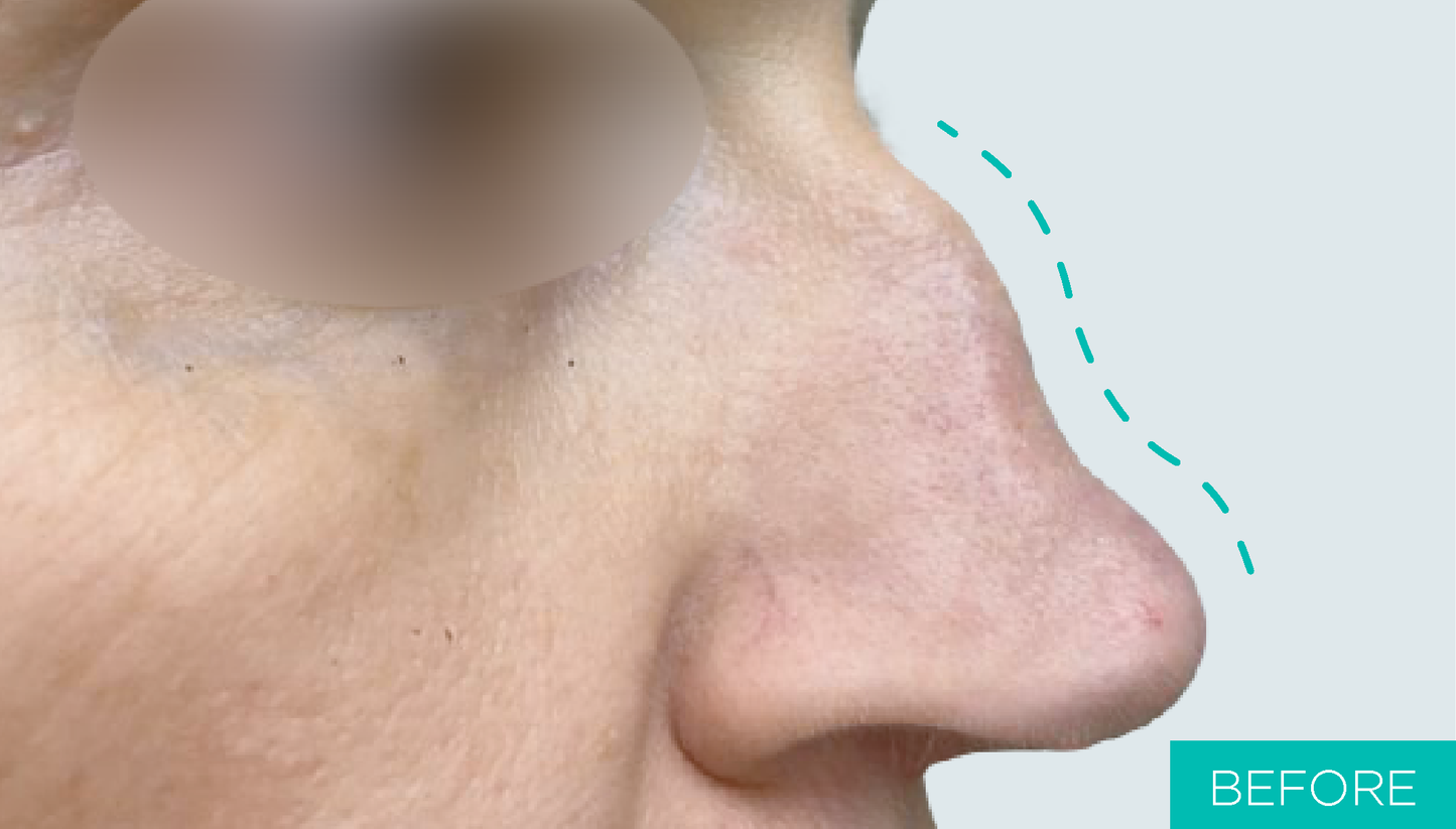 Before nose lifting with MINT PDO threads