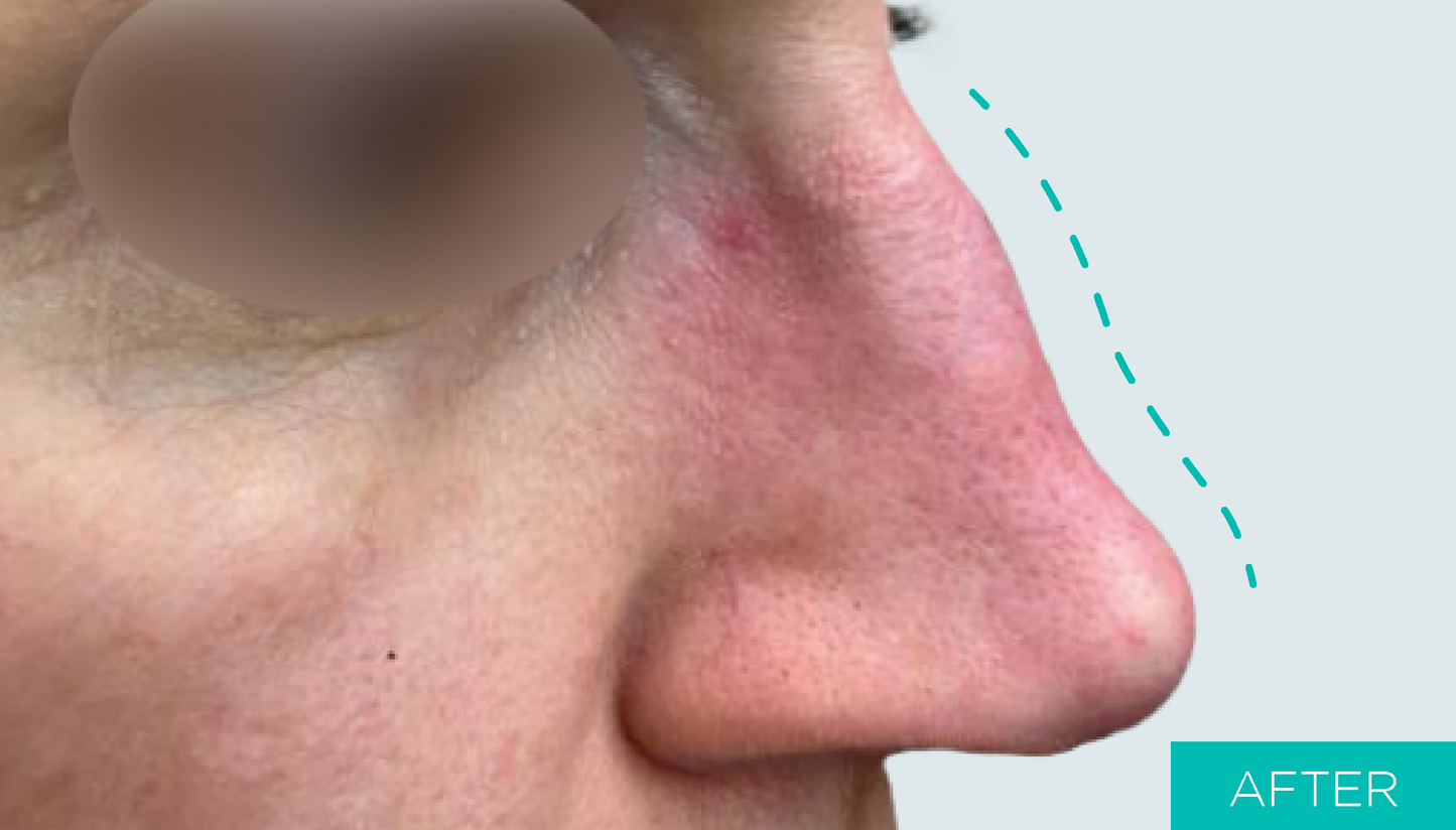 After nose lifting with MINT PDO threads