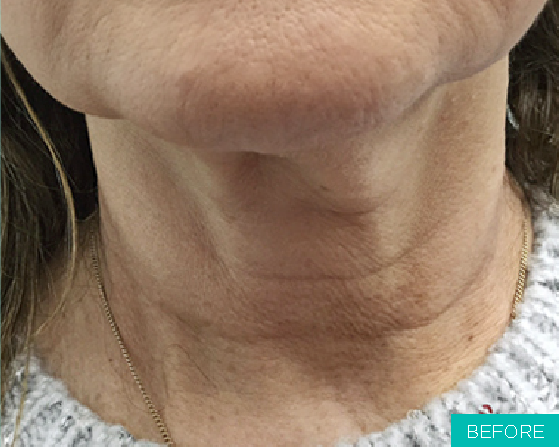 Before picture of neck lifting with MINT PDO threads