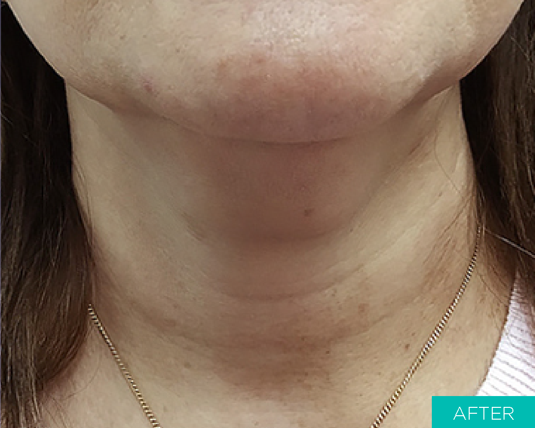 After picture of neck lifting with MINT PDO threads
