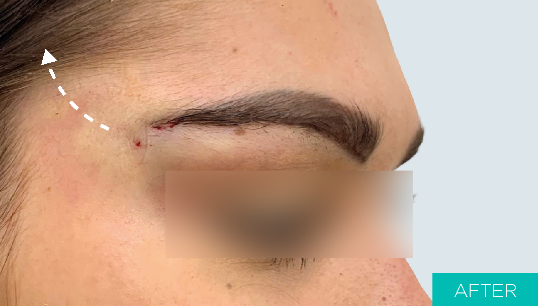 After Eye-brow Lifting with MINT PDO threads