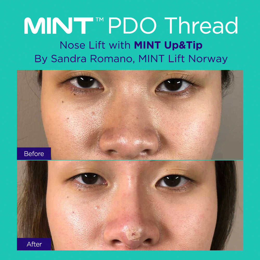 Nose Treatment MINT™ PDO & Klàrdie Manufacturer