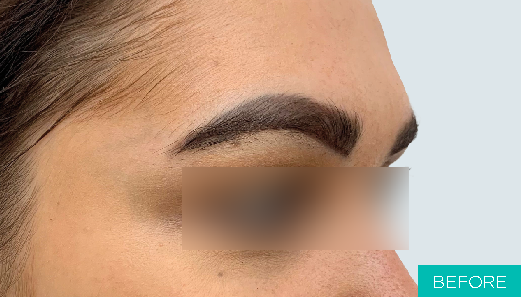 Before Eye-brow Lifting with MINT PDO threads